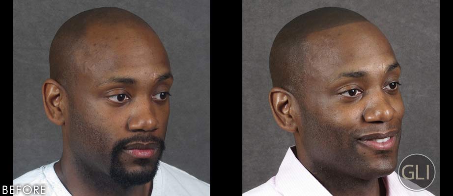 SMP for Balding Before & After - Prince side