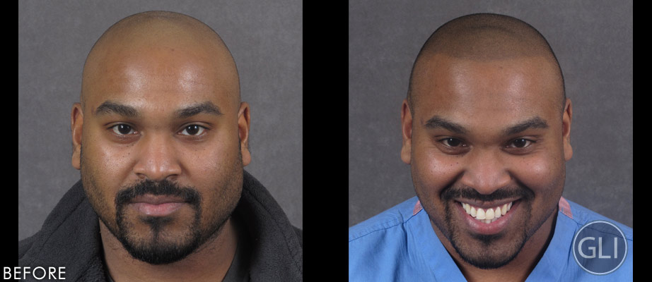 Dr. Balgobin's Scalp Micropigmentation before & after front