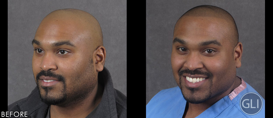 SMP for balding before & after - Dr. Balgobin side